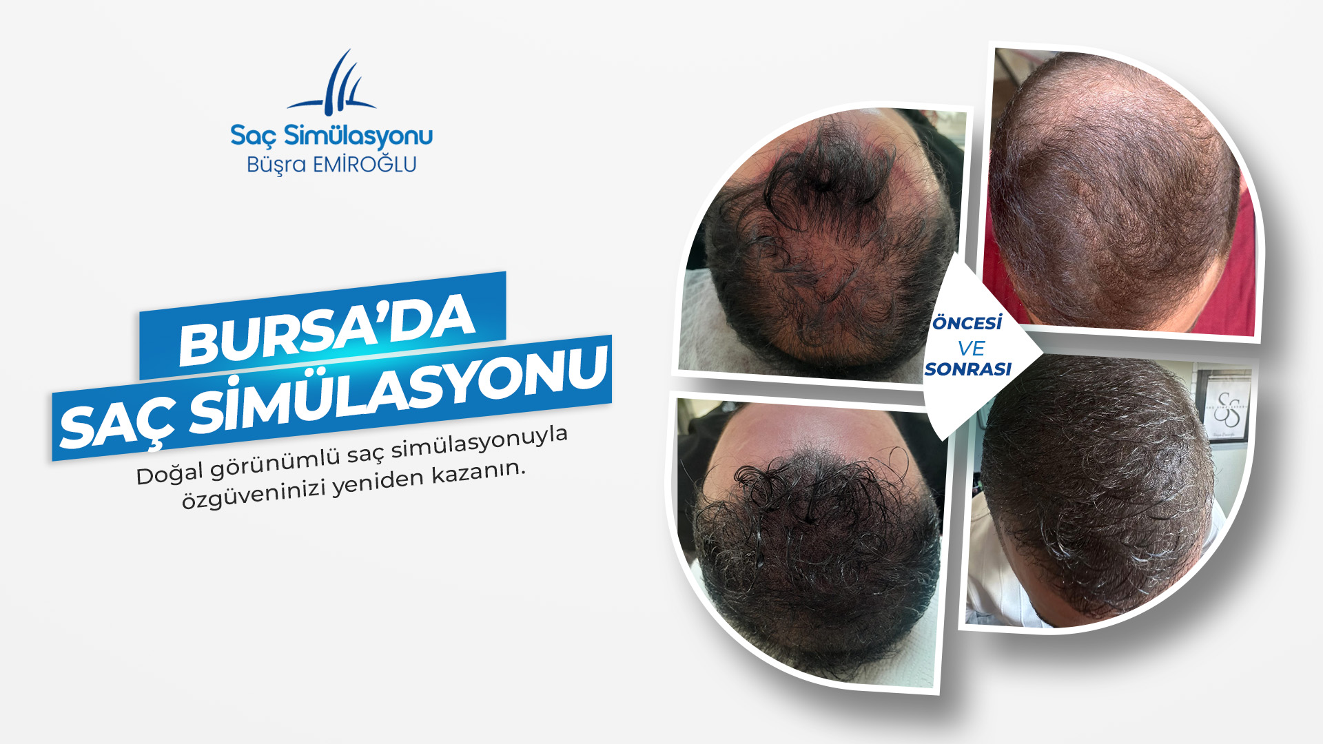 bursa-sac-simulasyon3